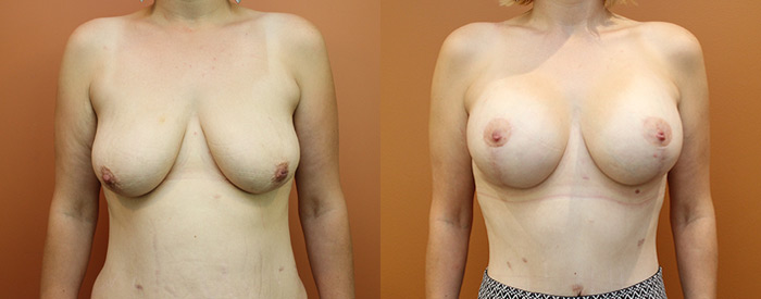 Breast Lift With Implants — 300HP Sub Pect — Front View