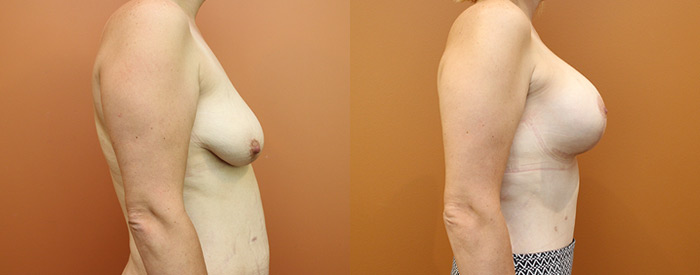Breast Lift With Implants — 300HP Sub Pect — Side View