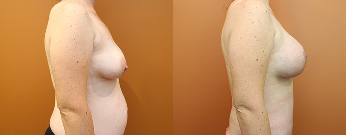 Breast Lift With Implants — Side View