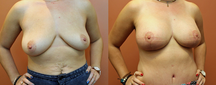Breast Lift With Implants — Angle View
