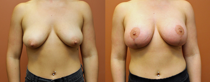 Breast Lift With Implants — Front View