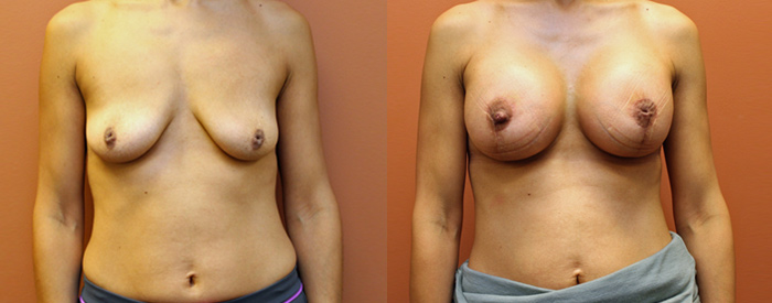 Breast Lift With Implants — Front View