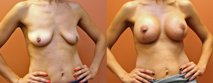 Breast Lift With Implants — Angle View