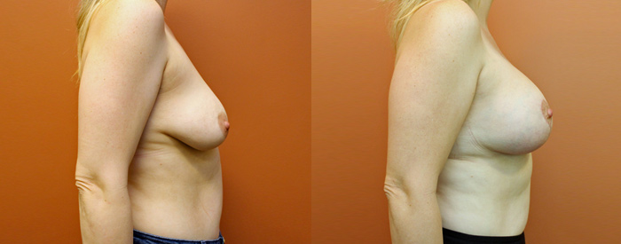 Breast Lift With Implants — Side View