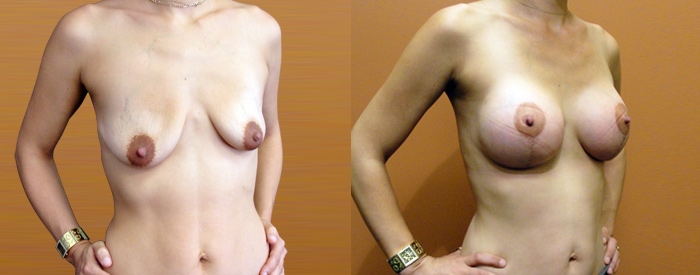 Breast Lift With Implants Patient 1 — Angle View