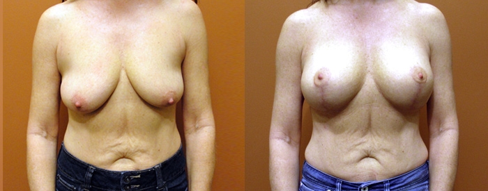 Breast Lift With Implants Patient 3 — Front View