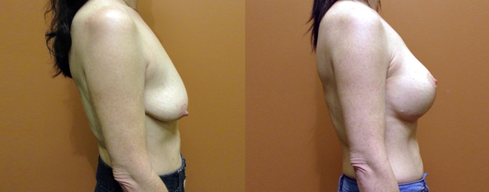 Breast Lift With Implants Patient 3 — Side View