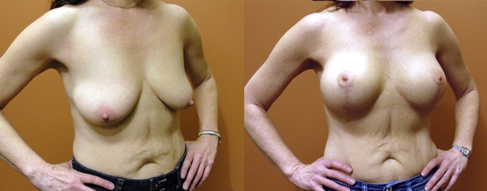 Breast Lift With Implants Patient 3 — Angle View