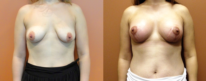 Breast Lift With Implants Patient 4 — Front View