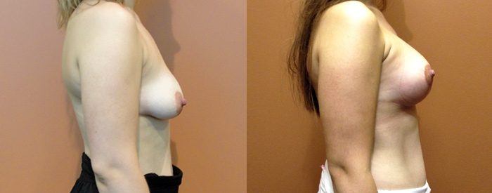 Breast Lift With Implants Patient 4 — Side View