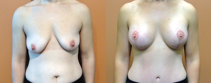 Breast Lift With Implants Patient 5 — Front View
