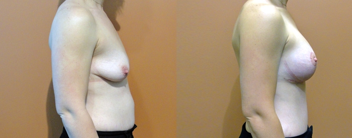 Breast Lift With Implants Patient 5 — Side View