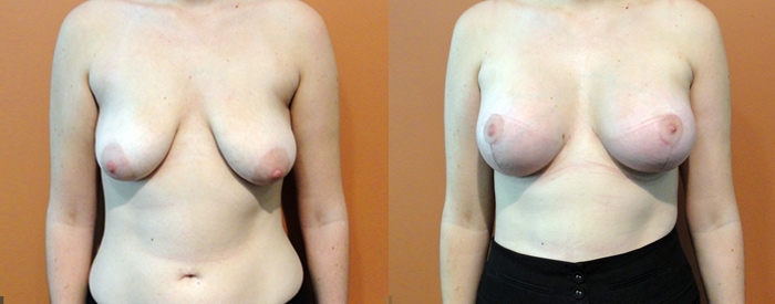 Breast Lift With Implants Patient — Front View