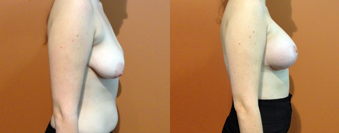 Breast Lift With Implants Patient 6 — Side View