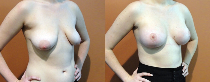 Breast Lift With Implants Patient 6 — Angle View