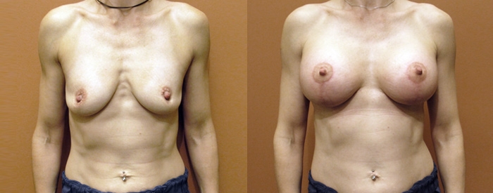 Breast Lift With Implants Patient 7 — Front View