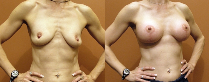 Breast Lift With Implants Patient 7 — Angle View