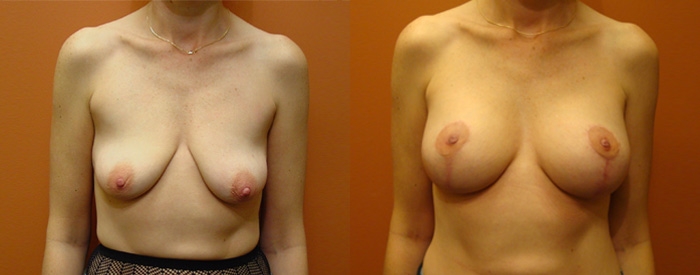 Breast Lift With Implants Patient 8 — Front View