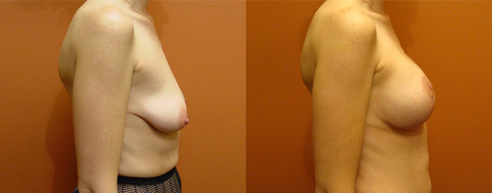 Breast Lift With Implants Patient 8 — Side View