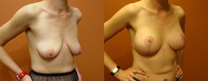 Breast Lift With Implants Patient 8 — Angle View