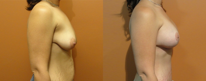 Breast Lift With Implants Patient 10 — Side View