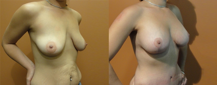 Breast Lift With Implants Patient 10 — Angle View