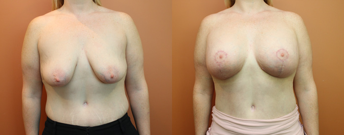 Breast Lift With Implants Patient 11 — Front View