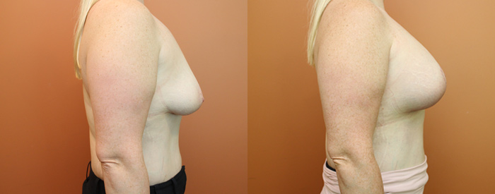Breast Lift With Implants Patient 11 — Side View