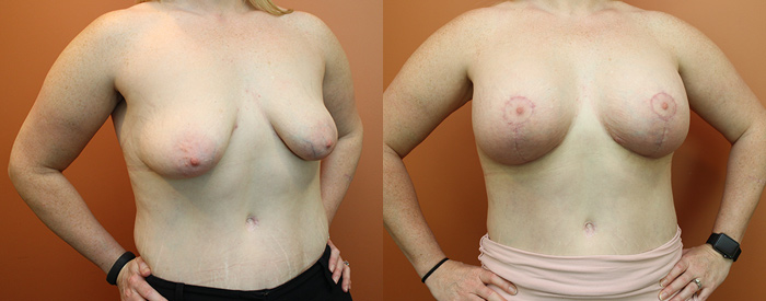 Breast Lift With Implants Patient 11 — Angle View