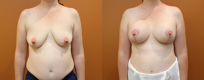 Breast Lift With Implants Patient 12 — Front View