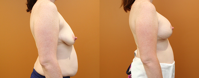 Breast Lift With Implants Patient 12 — Side View