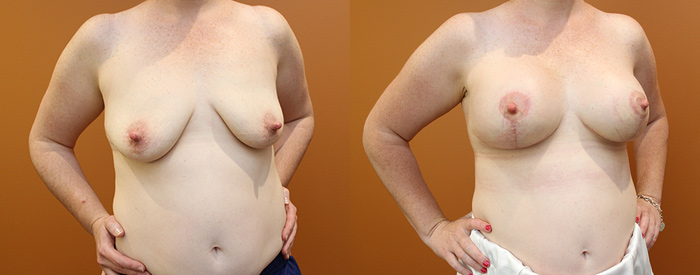 Breast Lift With Implants Patient 12 — Angle View