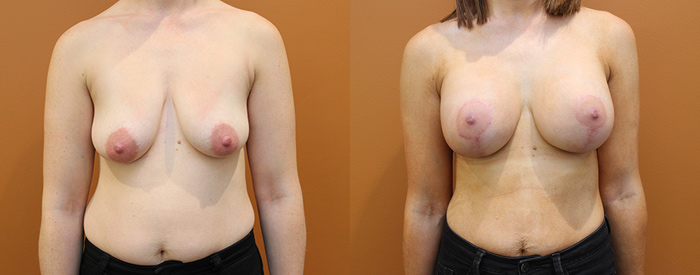Breast Lift With Implants Patient 14 — Front View