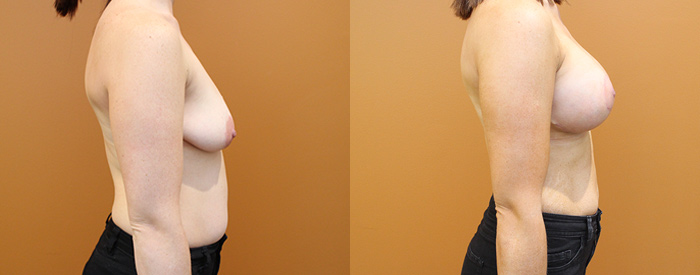 Breast Lift With Implants Patient 14 — Side View