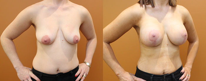 Breast Lift With Implants Patient 14 — Angle View