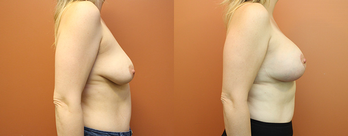 Breast Lift With Implants Patient 15 — Side View