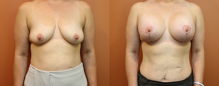 Breast Lift With Implants Patient 16 — Front View