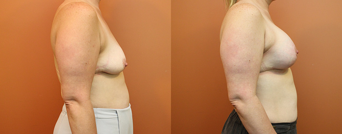 Breast Lift With Implants Patient 16 — Side View