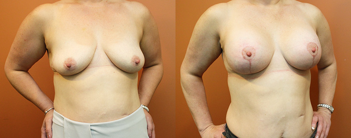 Breast Lift With Implants Patient 16 — Angle View