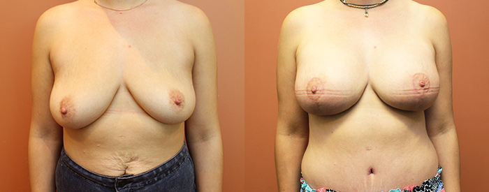 Breast Lift With Implants Patient 17 — Front View