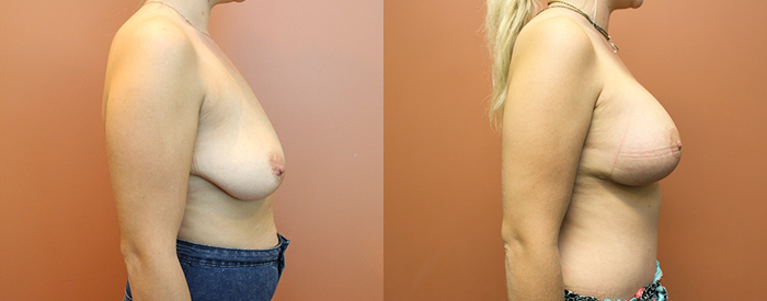Breast Lift With Implants Patient 17 — Side View