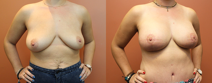 Breast Lift With Implants Patient 17 — Angle View