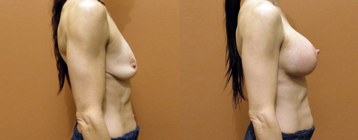 Breast Lift With Implants Patient 7 — Side View
