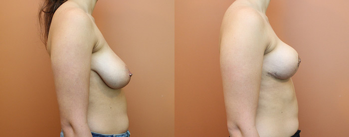 Breast Lift Without Implants — Side View