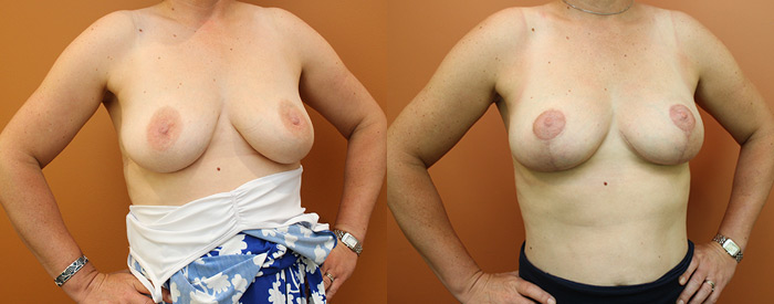 Breast Lift Without Implants — Angle View