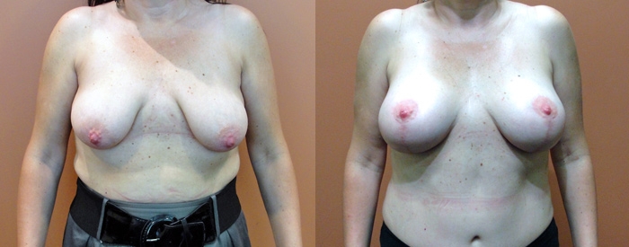 Breast Lift Without Implants Patient 1 — Front View