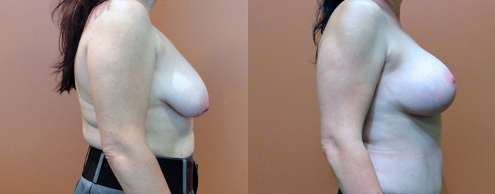 Breast Lift Without Implants Patient 1 — Side View