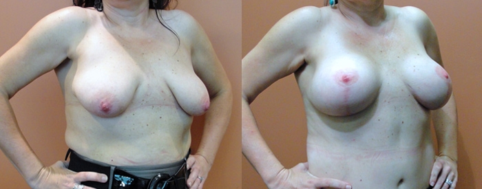 Breast Lift Without Implants Patient 1 — Angle View