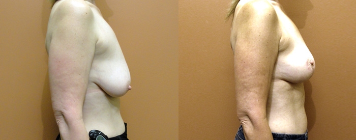 Breast Lift Without Implants Patient 2 — Side View