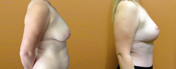 Breast Lift Without Implants Patient 3 — Side View